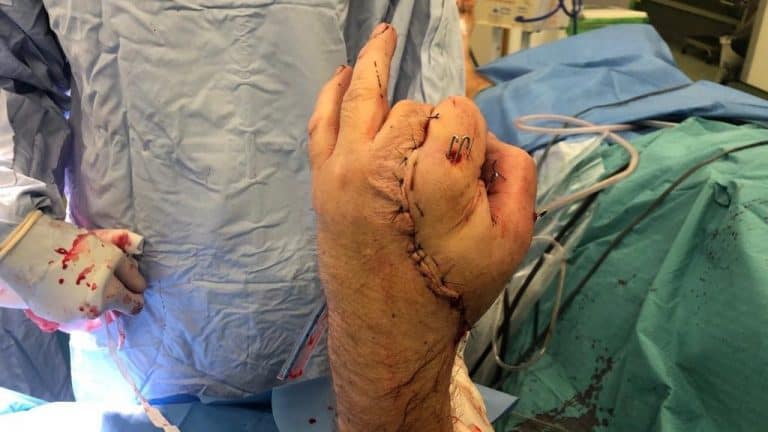 Surgeons Save Chippy’s Hand In 17 Hours Of Surgery